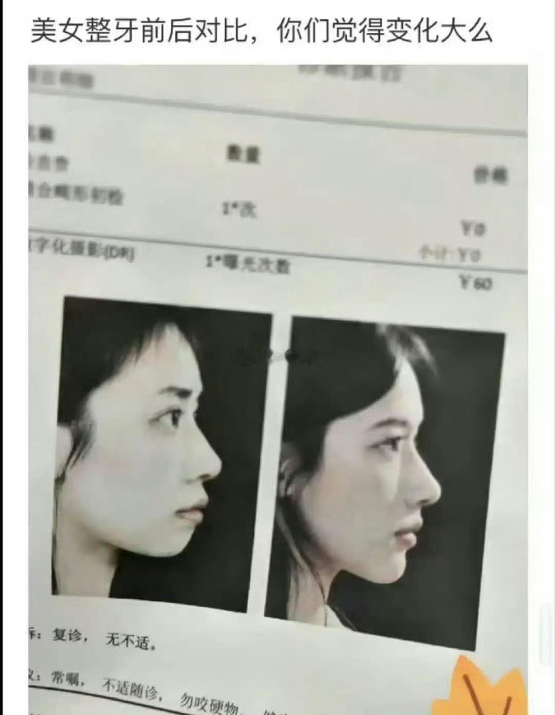 这哪是整牙的变化啊，这简直是进化了。 ​​​