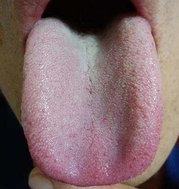 也不看看舌头都凹呈啥样了，怪不得会经常浑身没力，那方面也不行！

如果你的舌头也