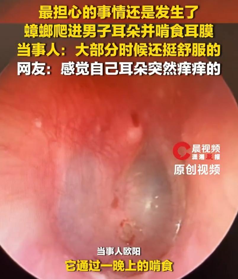 就在网上那篇“耵聍自行脱落”的帖子还让欧阳先生觉得新奇不已、笑谈而过的几天后，令
