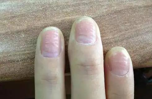肾“衰”手先知，手上出现这3种现象，多是肾不好的表现
 
1. 手指发麻
因为当