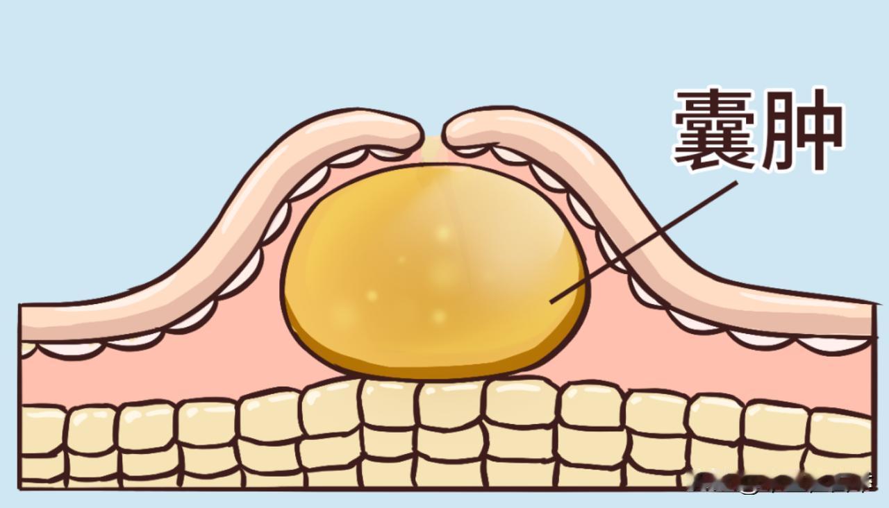 囊肿患者吃桂枝茯苓丸、血府逐瘀丸没效果？
从中医角度来看，囊肿的形成与气血运行不