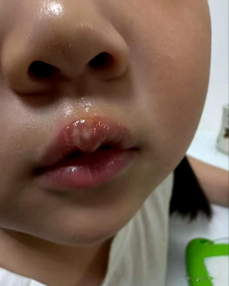 光天化日，直接拿热熔枪烫娃嘴，这老师还是人吗？

看完监控我都气得手抖！江苏徐州