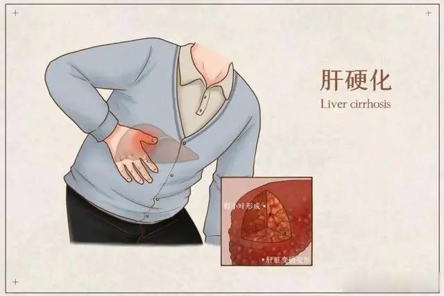 肝硬化了，如何让肝“软”下来？肝硬化属于肝病终末期的一种表现，随着肝脏由“软”变