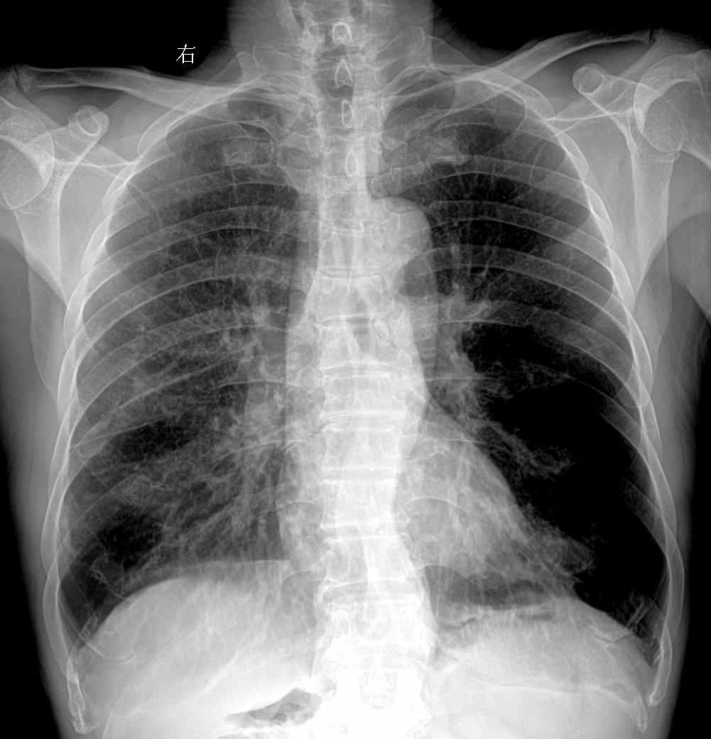 男70岁胸闷咳嗽一周就诊