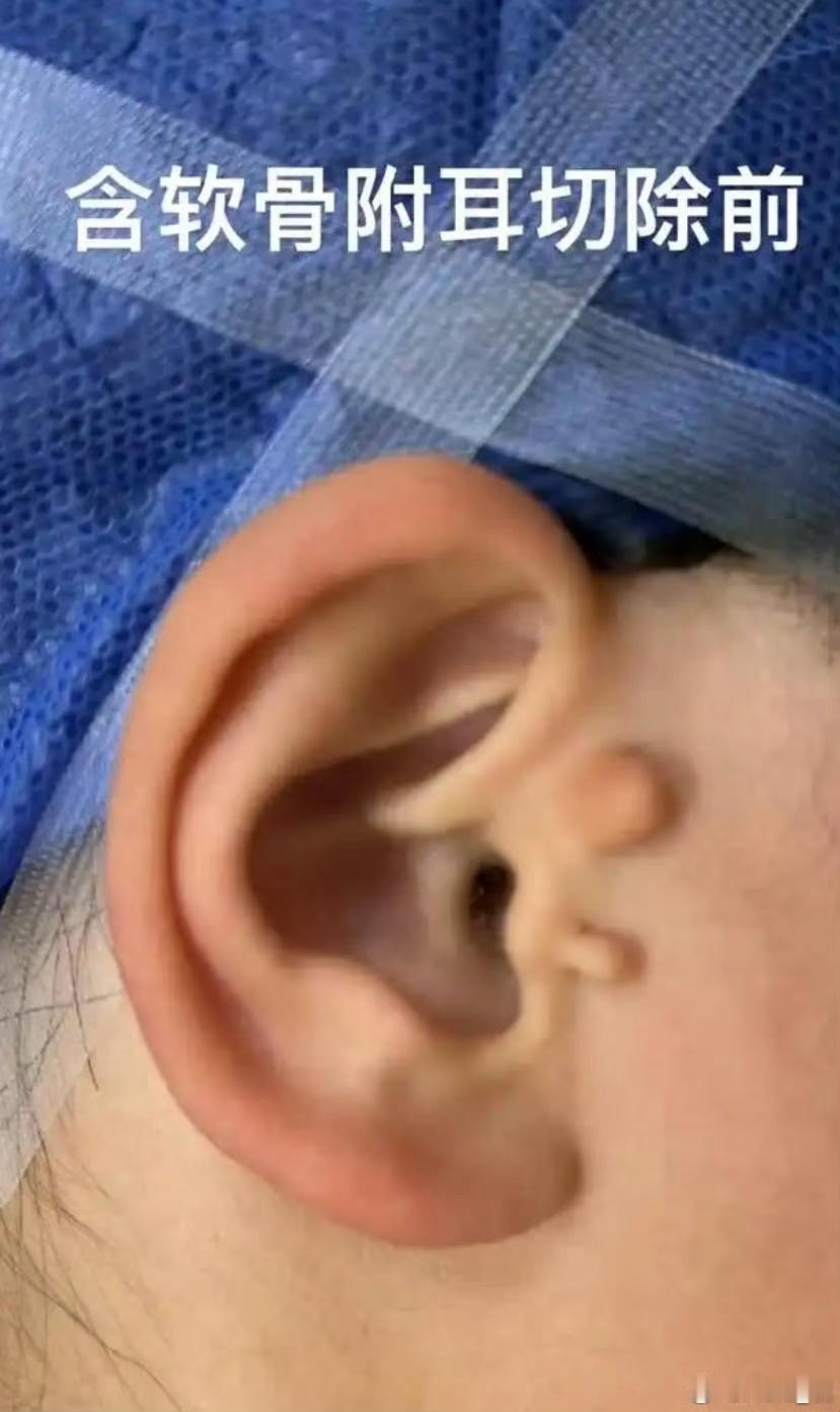 你们见过6️⃣個耳朵的人吗❓我小学🏫同桌——陈浩就🈶六个耳朵、👂👂👂?