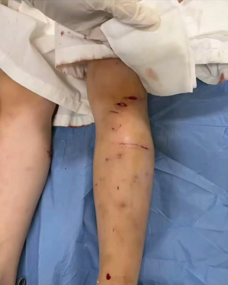 苏州遛狗不拴绳咬伤两名幼童 遛狗不栓绳真是太毁人了，宠物狗就是要栓绳 