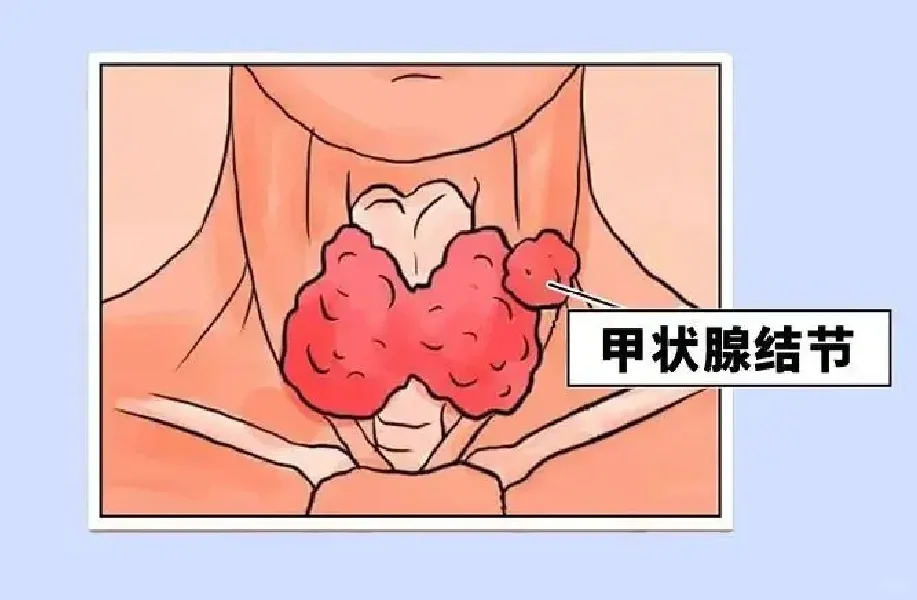 新版美国ATA甲状腺指南更新甲结节风险分层