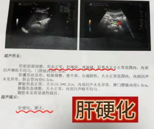 肝病患者报告单，警惕这4种描述！