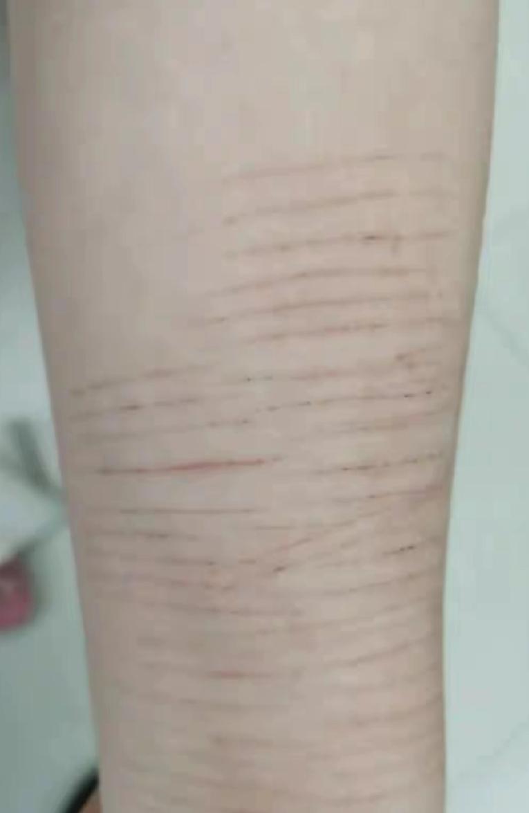 孩子胳膊上划上这样叫没事？
这父母真是太大意了！
老师发现后告诉孩子的父母，
结