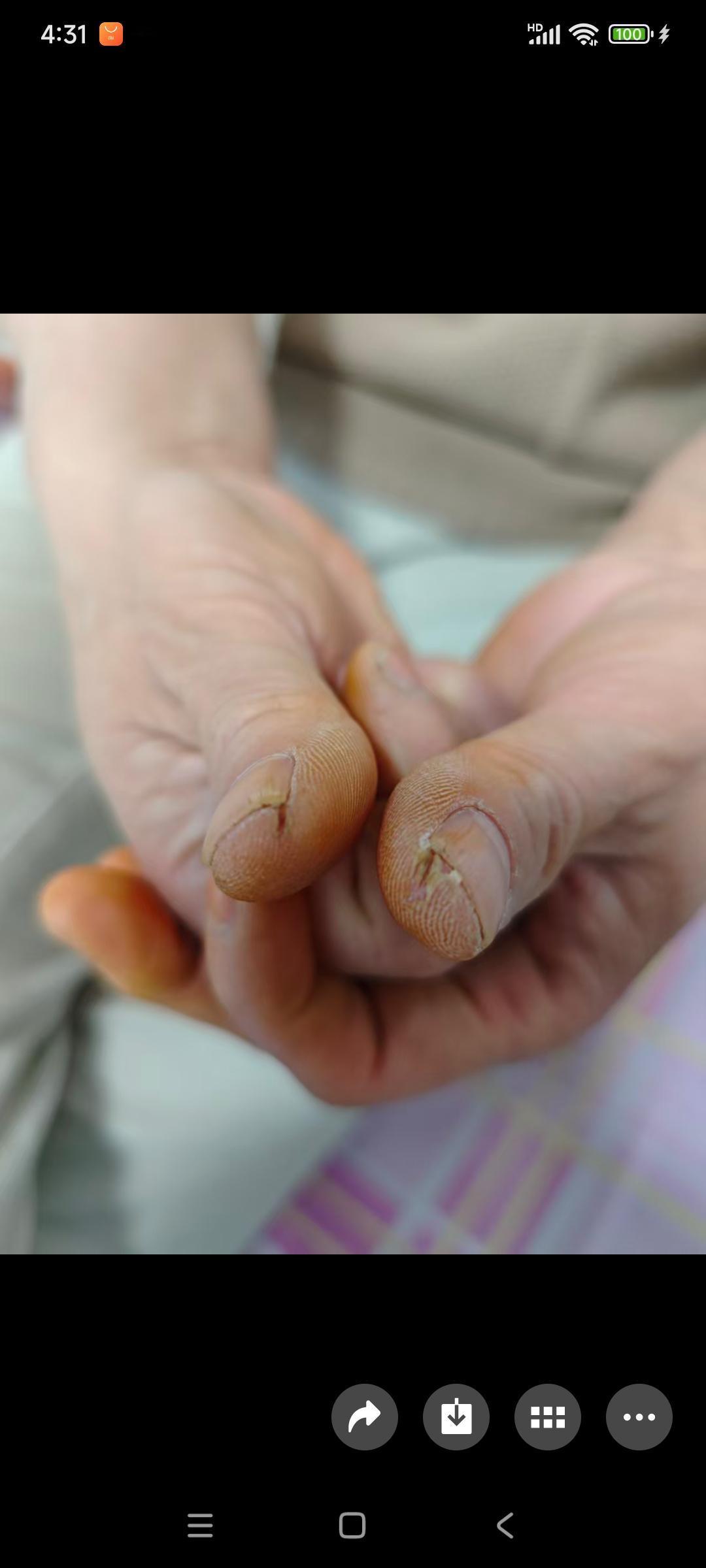 这手咋这烦人，
每年冬天都裂好几次口子，
都是手指头边，
这个裂完那个裂，
一个