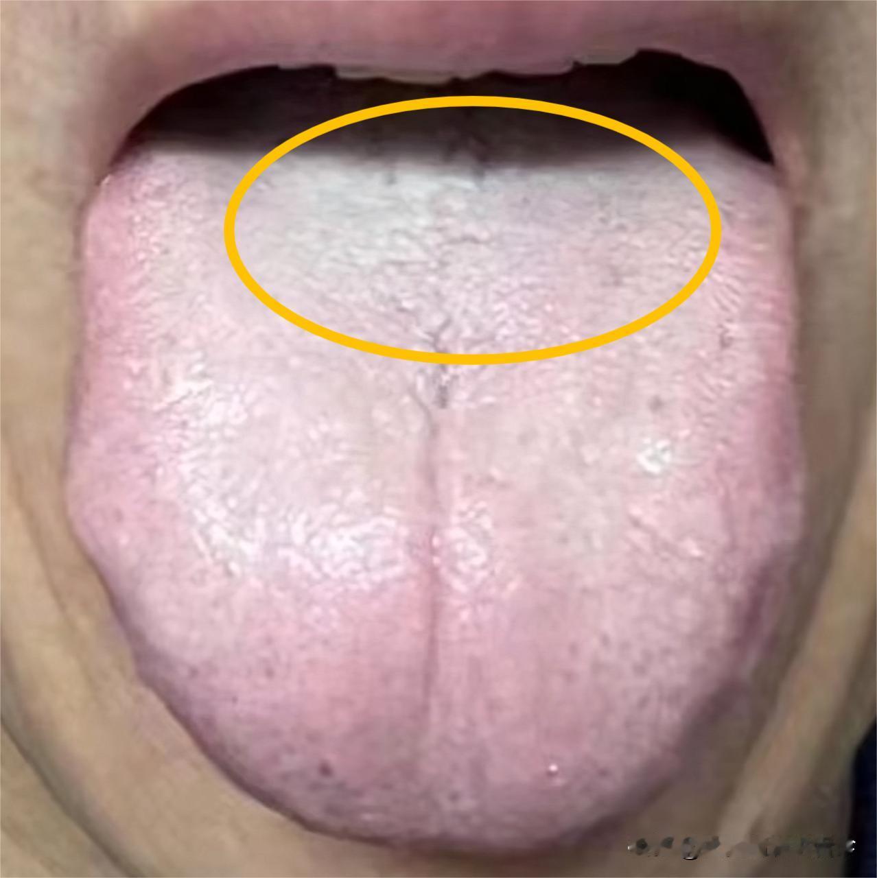 补肾最快的方法，就是看舌根——白补肾阳，凹补肾气，红补肾阴！

1、白补肾阳——