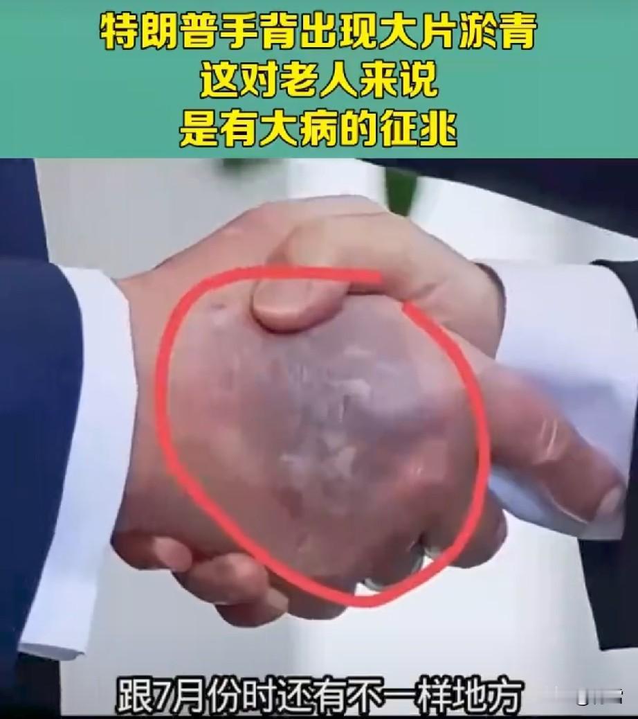 特郎普主动停止打击伊朗，可能是因为他的身体健康出了问题？
最近，华盛顿政治圈传出