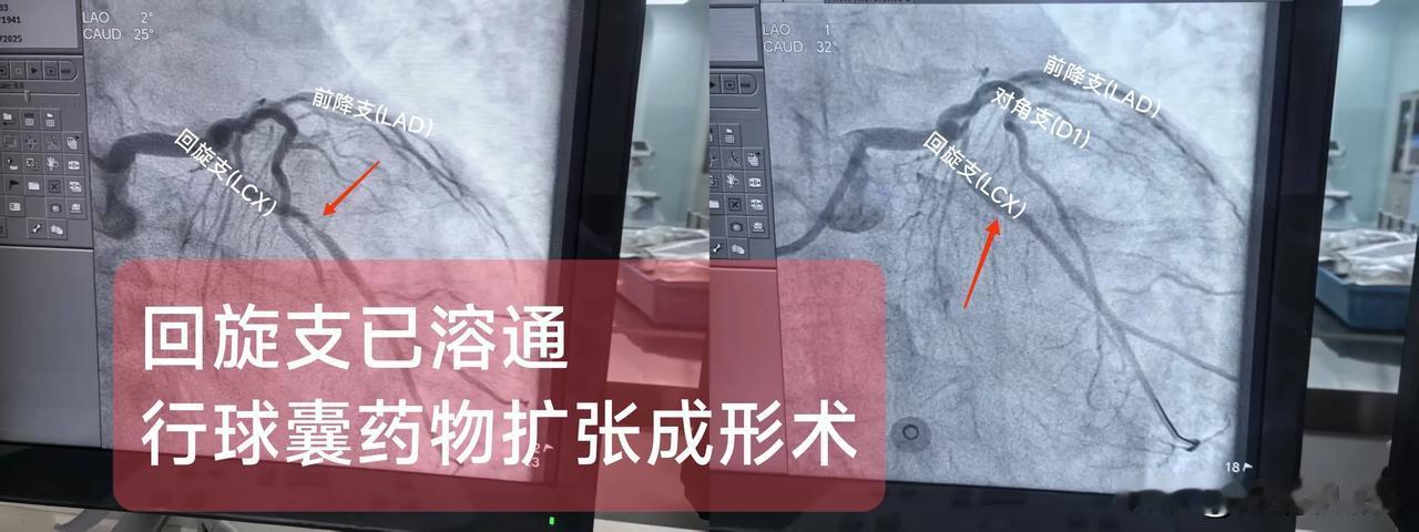 急性ST段抬高型心肌梗死
（回旋支中段溶栓已通）
概念：回旋支与前降支共同起自于