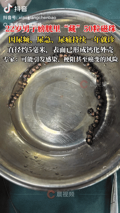 简直离谱！”湖南长沙一名22岁男子因小便刺痛、尿频尿急持续了一年才去医院检查，结