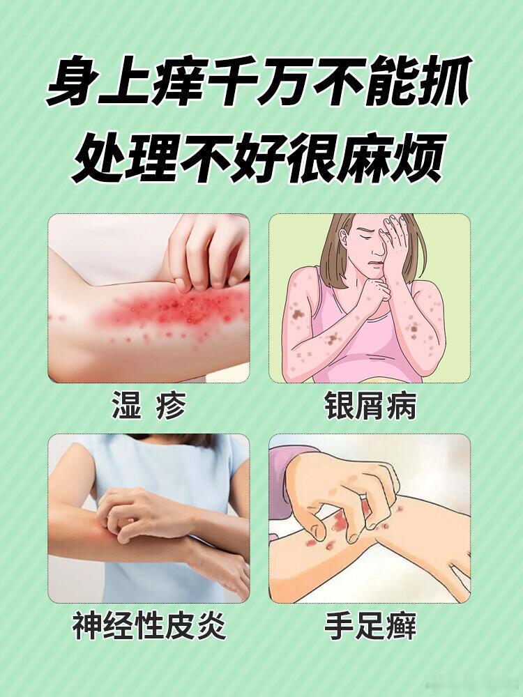 得皮炎后我先去挂了心理科皮炎和心理状态互相影响，焦虑压力容易加重皮肤问题。兼顾皮