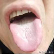 舌头变成这样，就要肝脾肾同治，否则就是拆东墙补西墙（粉丝舌象分析）

看到这个舌