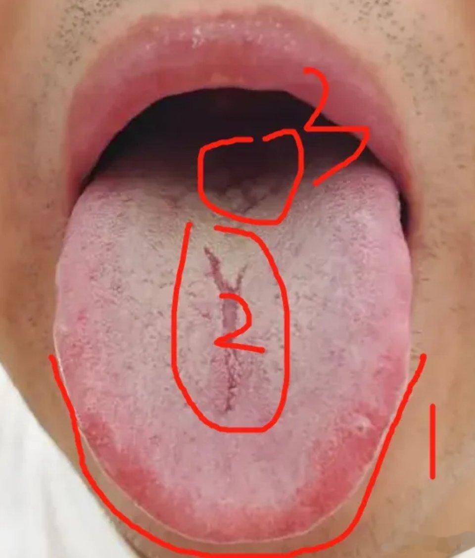 【每日患者舌苔分析：上热下寒，肝郁】①舌尖和两侧红，说明上焦心肝有火，还有肝郁情