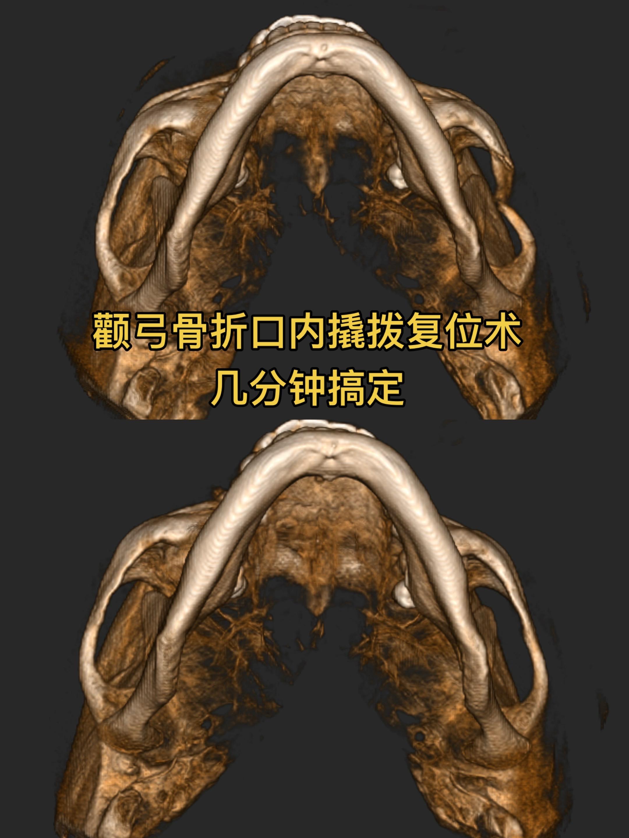 颧弓骨折的口内撬拨复位术。无面部切口，省钱，效果也很好。