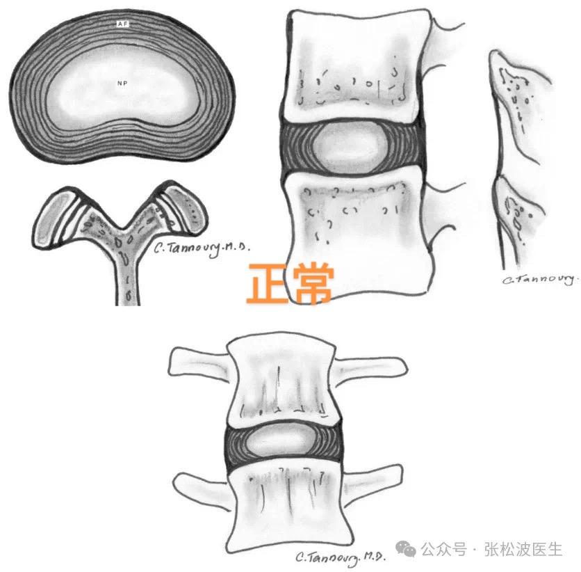 椎间盘膨出、突出、脱出、游离、内突区别。椎间盘膨出、突出、脱出、游离...