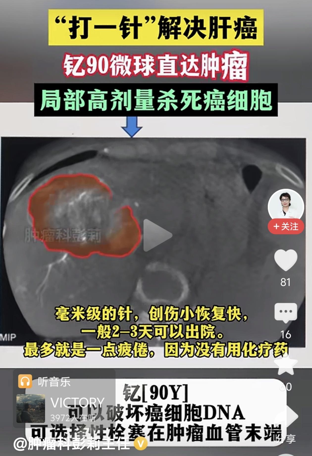 作为一项尖端技术，钇90的治疗效果确实让人看到了希望。但说到老百姓最关心的费用问