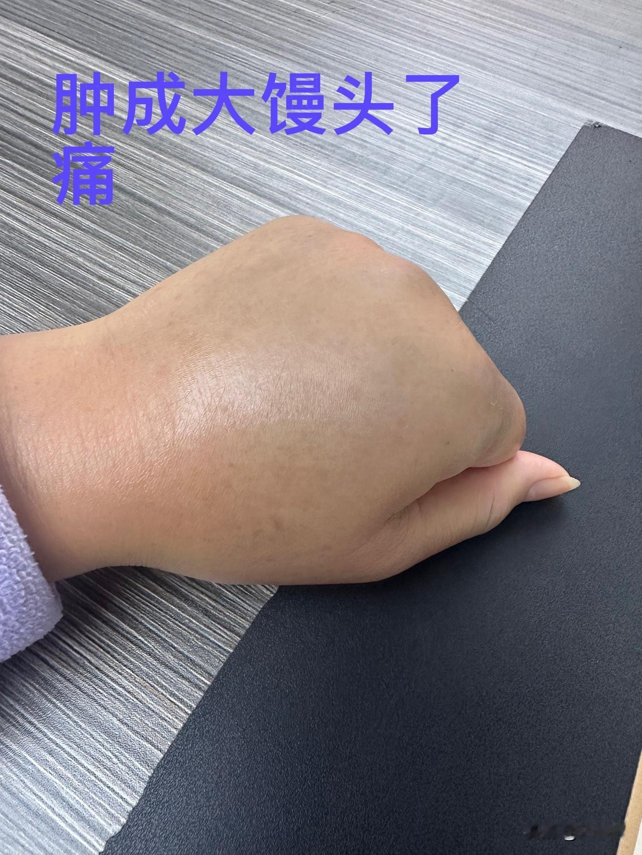 怎么办？手肿成这个样子，好几天都不能做事了。

昨天早上出门上班的时候，看到晾在