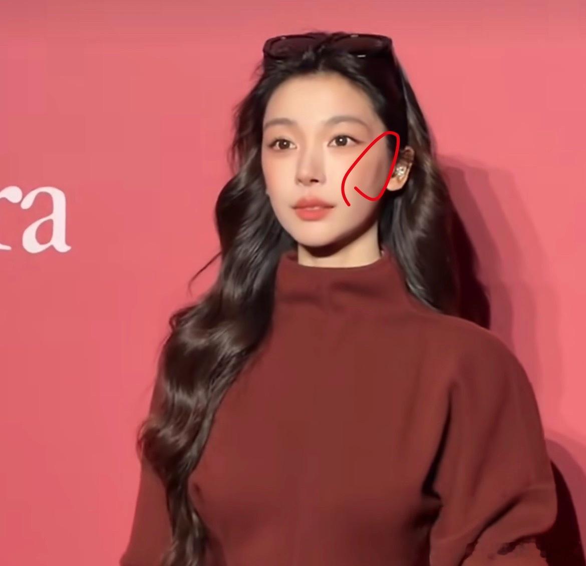 疑似易梦玲脸上做了线雕不懂线雕是什么医美项目，但是肉眼可见的脸色确实突出来一条，