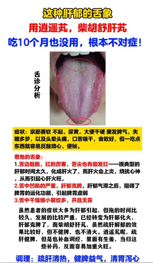 肝气郁结，吃了10月的逍遥丸，柴胡舒肝丸都没用？中医只用1招，疏肝解郁，脾胃好了
