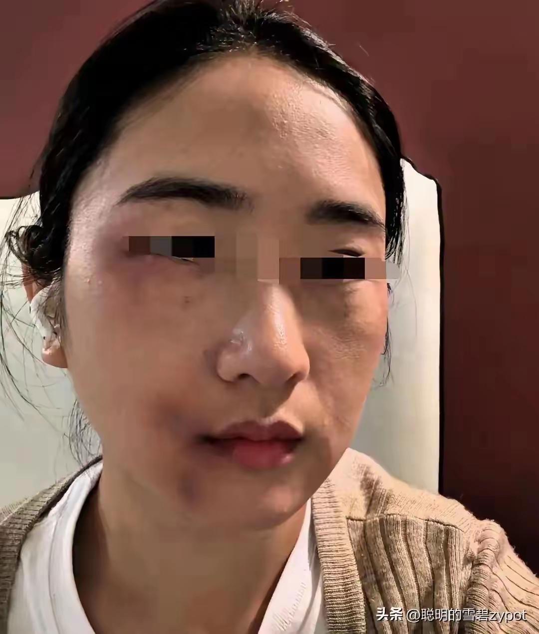 自家姐姐遭丈夫动手，弟弟拎钢管上门将姐夫打至骨裂，很多人第一反应只指责弟弟冲动伤