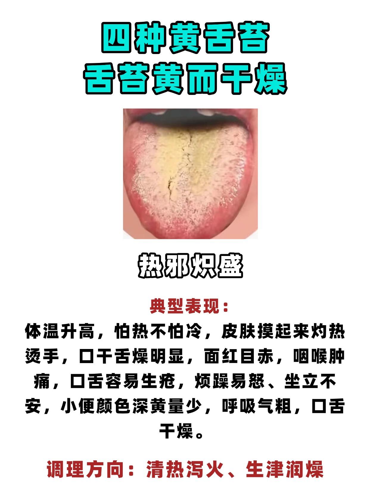 四种黄舌苔，舌苔黄而腻