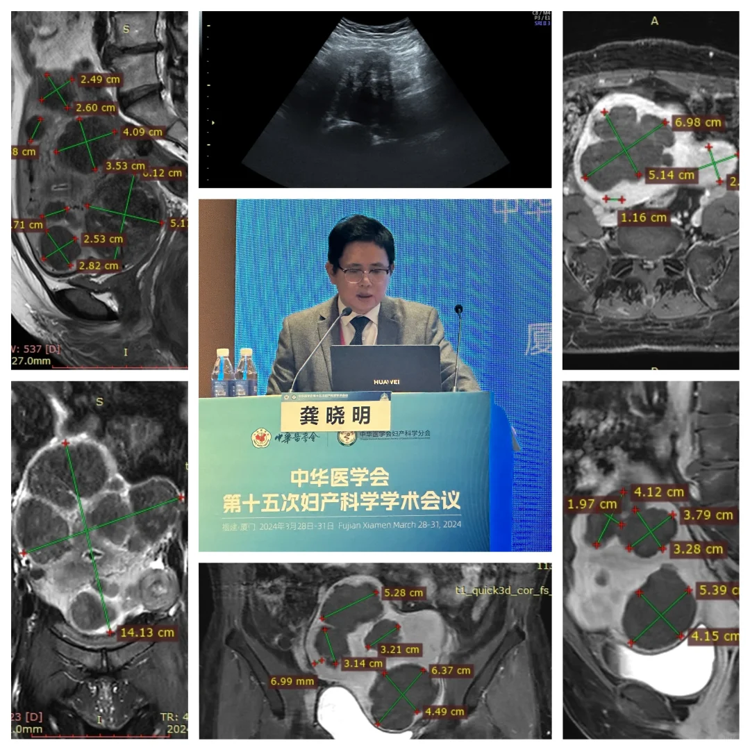 多发子宫肌瘤不一定需要开刀手术