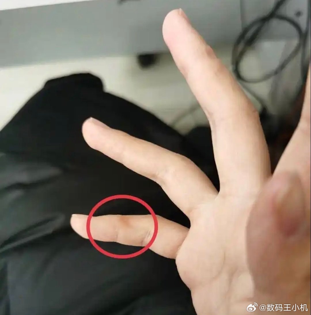 长期用小拇指托手机的后果我最近也在研究这个问题，这可咋整啊，小拇指感觉都变形了，