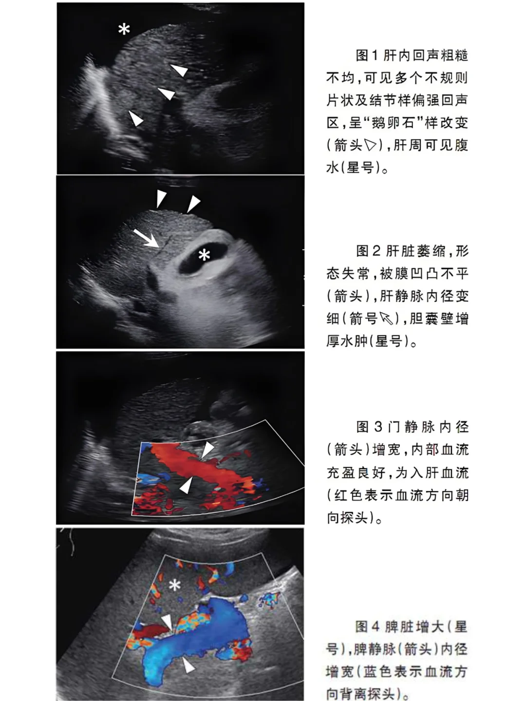 来看肝硬化患者的超声表现！