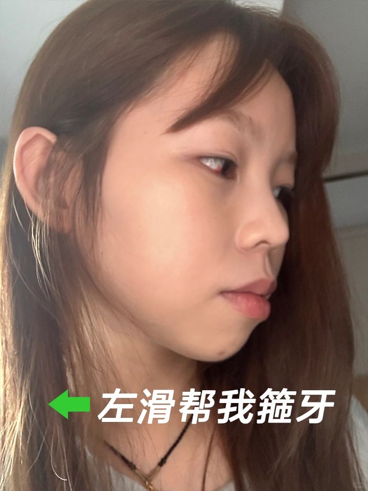 花了2w牙齿矫正，我后悔了吗[大哭]