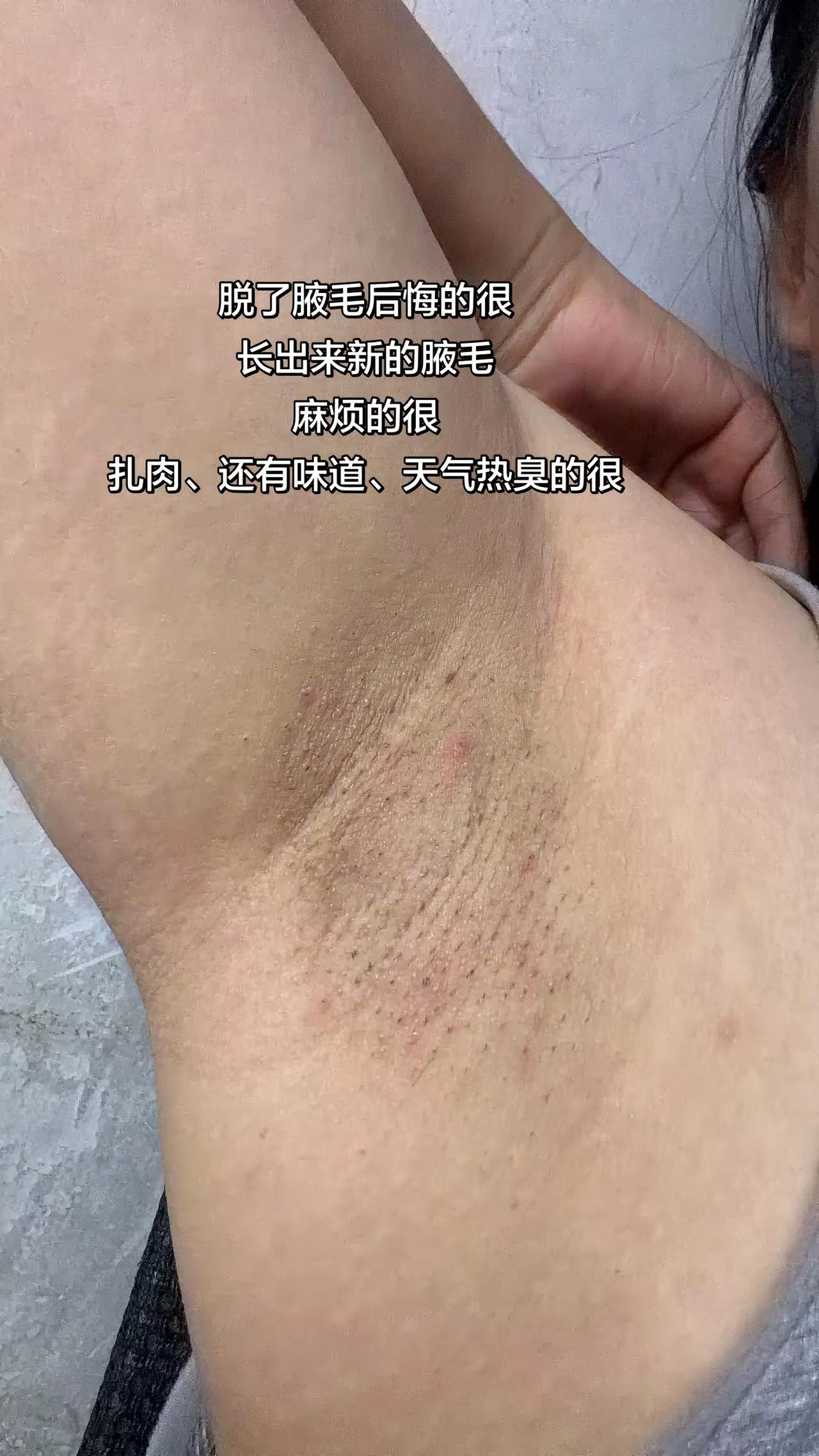 说的不好听点，女人的腋毛剃成这样，还真的不如不剃！像这个女人的腋窝本来就黑，有很