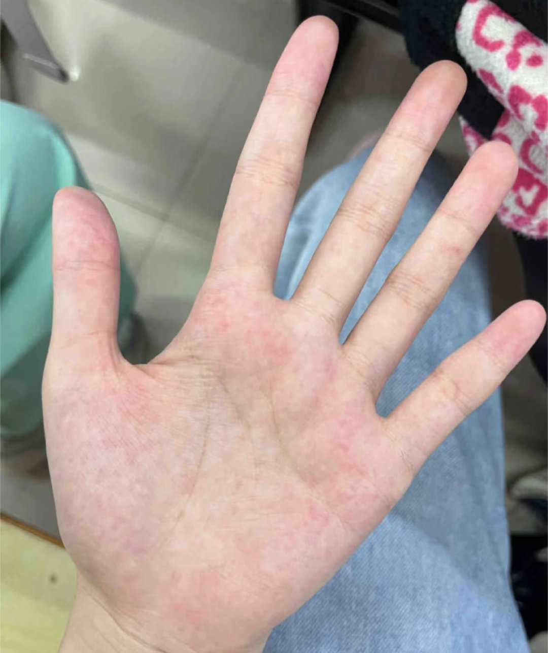 现在才知道雪花手其实是一种病我以前也这样，现在好了！ ​​​