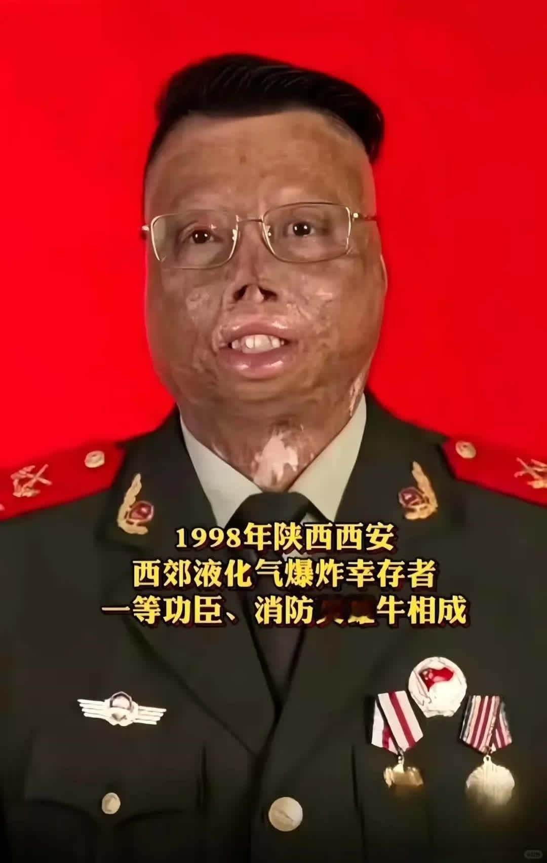 牛相成，他值得我们永远铭记！ 第一，97%烧伤面积，失去一条胳膊，难以想象他经历