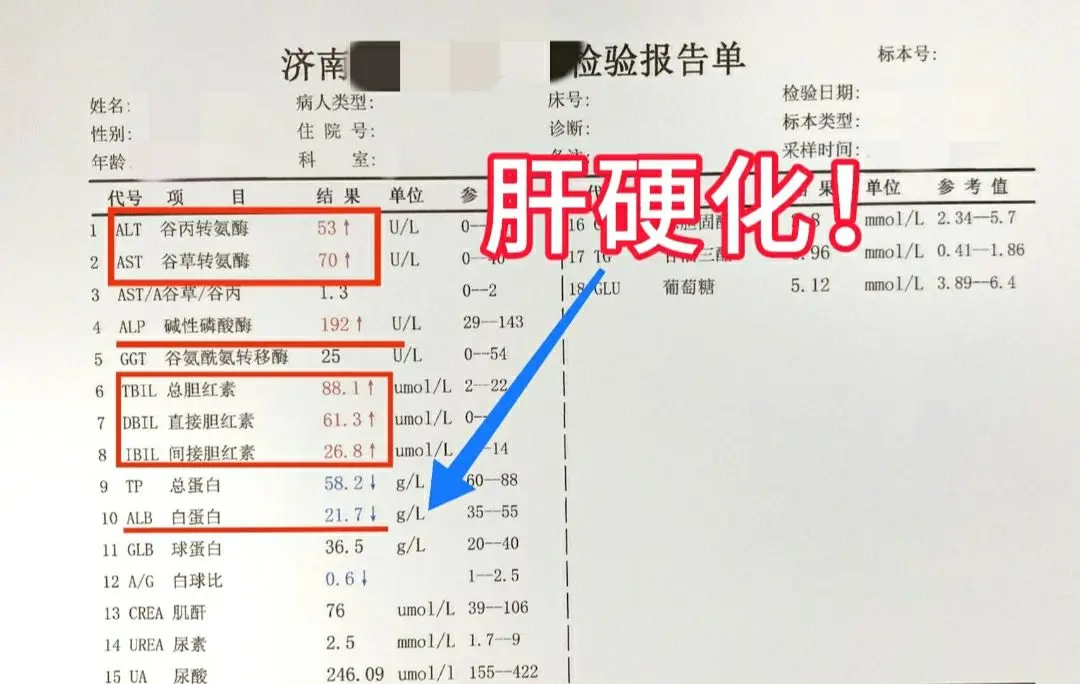 这是一位山东济宁患者的检查单，转氨酶轻度升高，但肝硬化了，患者病毒量小...