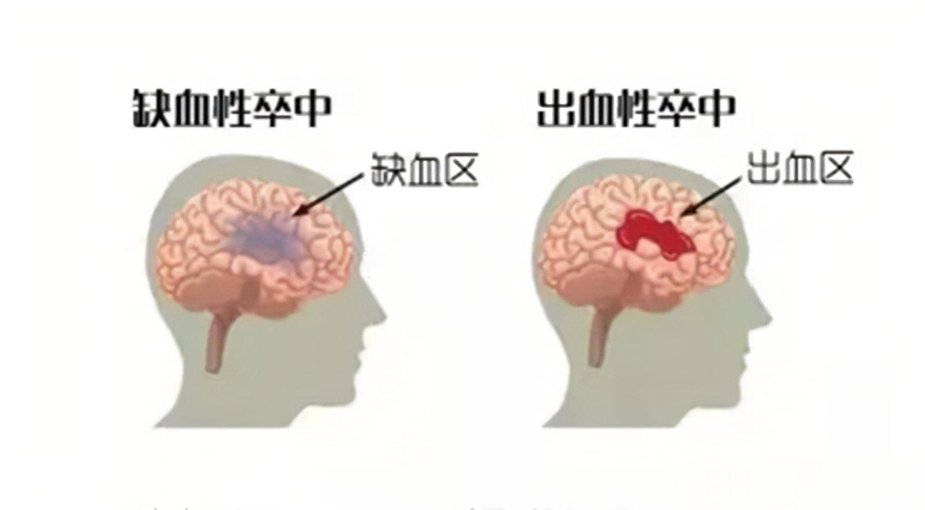 #全民慢病健康科普计划##这个问题吃什么##健康食验计划# 【如何快速识别脑卒中