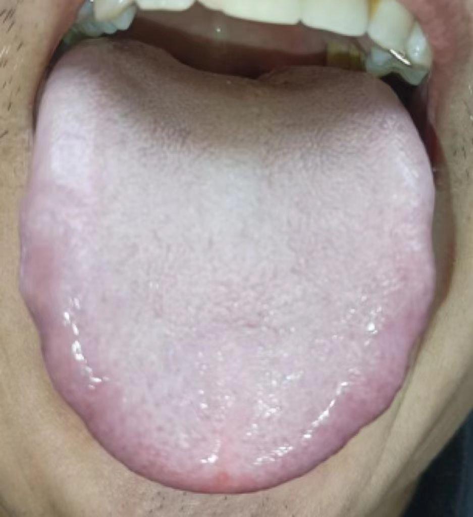 注意了，这种舌苔想要调理，就得一疏，二清，三进补，顺序一点不能乱！

这是个什么