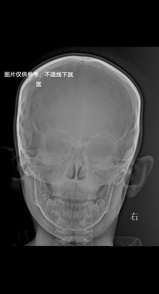 柯瓦氏位，副鼻窦有无问题家人们