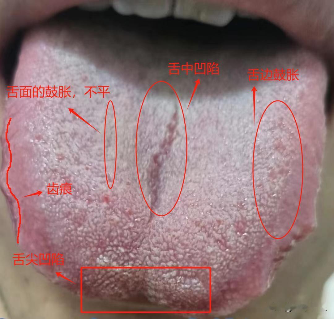 肝郁克脾还有湿寒就别用柴胡舒肝丸了，没效果了已经

真是见到这样的舌头就头疼，肝