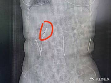 【#女子误吞假牙后金属钩挂住肠壁#】#女子吃饭误吞假牙20多天才就医#5月13日
