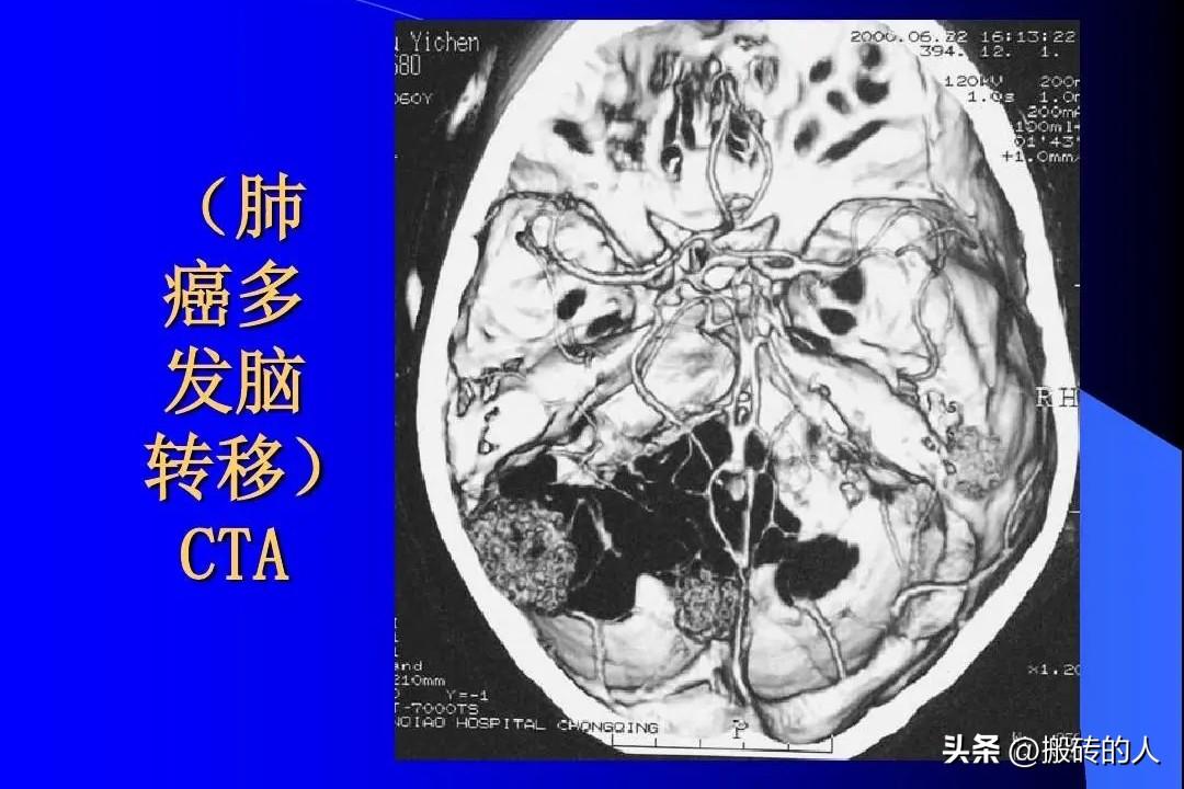 【牛博士前沿技术分析01】肺癌确诊有脑转移，前沿技术有突破吗？

这是ALK阳性