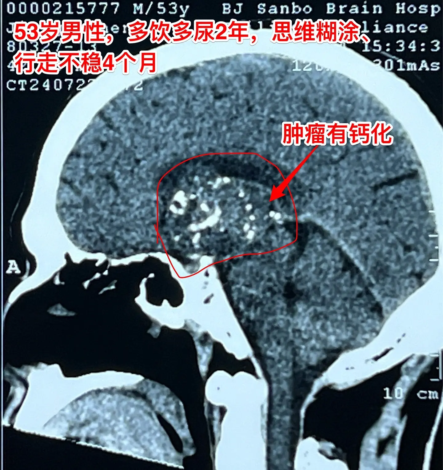 多饮多尿症状是肾脏出了毛病了？53岁的青岛男性，多饮多尿两年了。是不是...