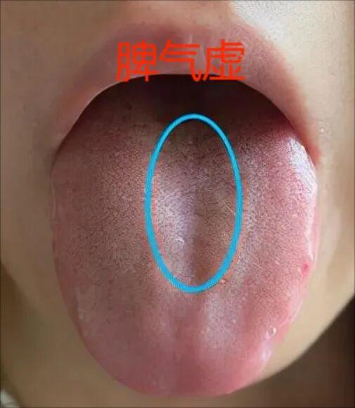 气虚不难辨，舌头有迹可循，为你解锁！
脾气亏虚——舌中部低洼
辨识关键：脾是气血
