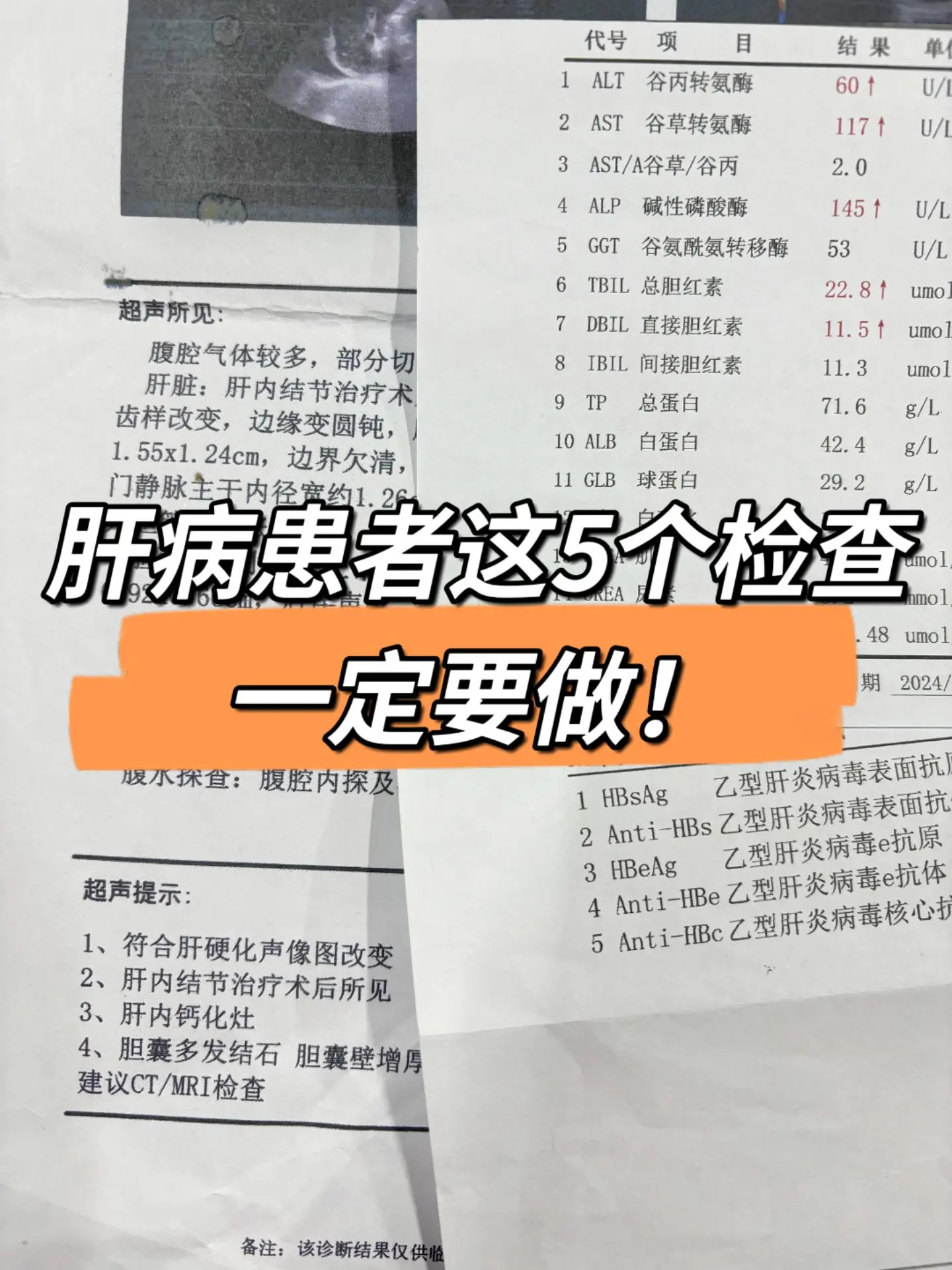 肝病患者这5个检查一定要做！1．肝胆脾彩超（可以发现肝脏大小是否异常...