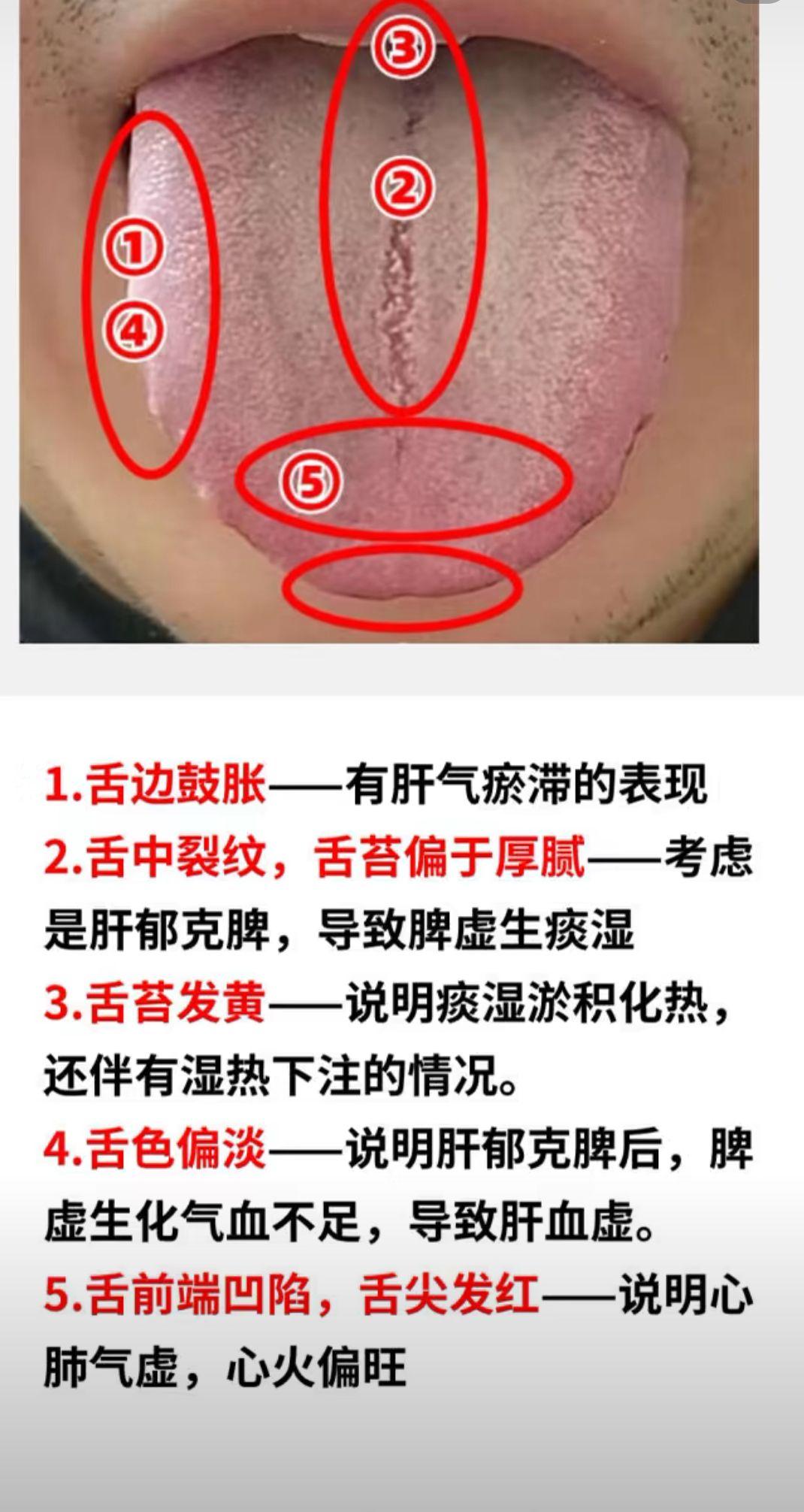舌象分析：不是肝郁 而是脾虚