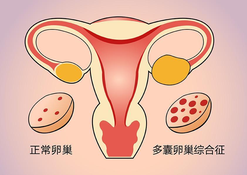 #健康真探社#【瘦多囊应该怎么办？】PCOS(多囊卵巢综合症)是一个不期而至的困