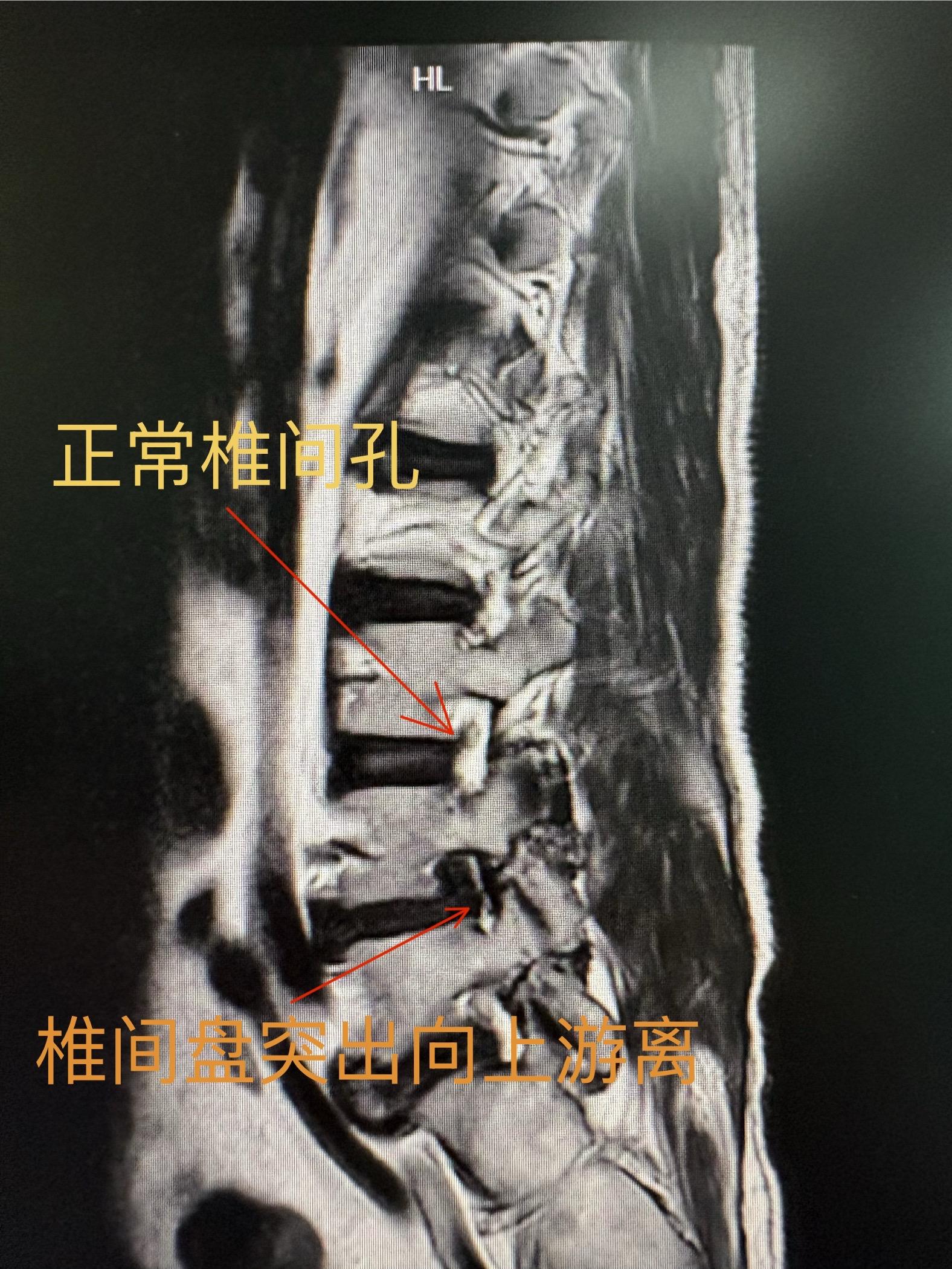 极外侧腰椎间盘突出。少见但往往症状很重，需要手术。