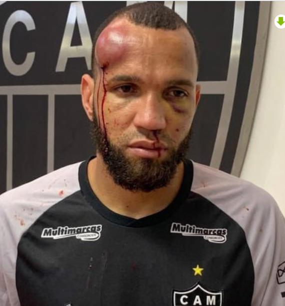 巴西23人红牌的罪魁祸首是是这个门将...当时他正用膝盖去攻击另一个球员的脸，结